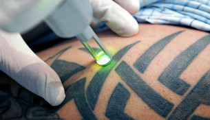 Удаление татуировки лазером